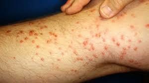 Hormigas rojas marcas de mordedura en las piernas humanas