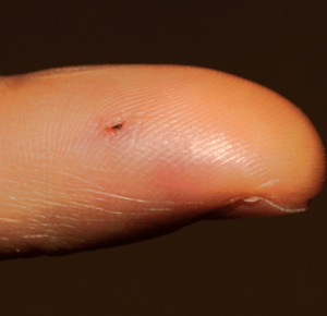 Mordedura de rata en el dedo