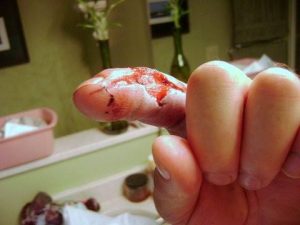 Mordedura de cobre en el dedo