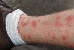 Marcas de mordedura de chigger en la pierna humana