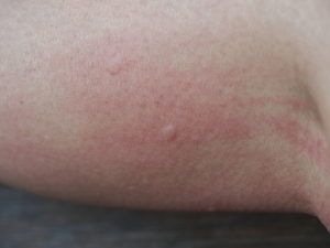 Marcas de mordedura de mosquito en la piel humana