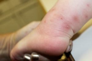 Marcas de mordedura de hormigas azules en la piel humana