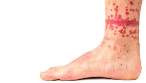 Picaduras de pulgas en las piernas humanas