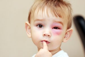 niño pequeño con un ojo hinchado