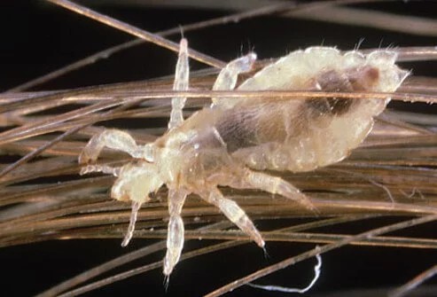 Piojos de cabeza dentro del cabello humano