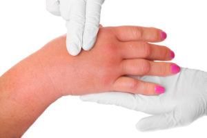 Una foto de una mano hinchada debido a una picadura de avispa que está siendo examinada por un médico sobre fondo blanco.