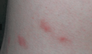 Mordeduras de pulgas en la cintura
